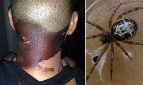 This is to prevent infection which will be infinitely worse than the bite. Pictured False Widow Spider Bite Turned My Neck Black Uk News Express Co Uk