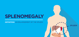 This pain may spread to your left shoulder. Six Spleen Facts Every Myelofibrosis Patient Needs To Know