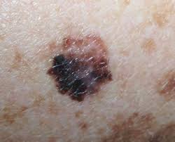 Of course, your specialist is the main person whose advice you should follow but it doesn't do anyone harm. Skin Cancer Types What Are The Types Of Skin Cancer Skin Cancer Signs