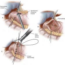 Abdominal exploration (laparoscopic or open); Minimally Invasive Ivor Lewis Esophagectomy Abdominal Key