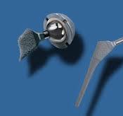 The Radiology Assistant : Arthroplasty of the Hip
