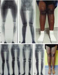 Image result for Genu Varum