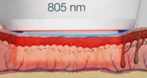 Find advanced laser hair removal device on offer from alibaba.com for various aesthetic and therapeutic treatments. Laser Hair Removal In Asheville Nc Complete Laser Treatment Clinic