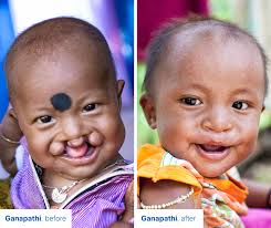 The birth of a newborn should be a time of celebration for every family.  However, the arrival of a child with a cleft condition often comes with  shock. This was the case