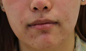 Pin On Acne