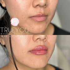 Giving her height, volume, and hydration while keeping it looking natural  ❤️ • • • Note: Numbing cream will be applied prior to treatment. Swelling  is expected and bruising is possible. Allow