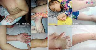 Ada banyak jenis surat yang masih dipertahankan sampai saat ini. Ayah Bayi Dijangkiti Hfmd Kongsi Cara Isterinya Rawat Anak Yang Kini Beransur Pulih Pa Ma