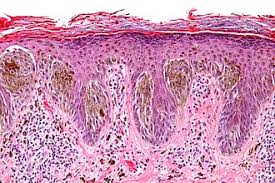 Image result for Spitz Nevus