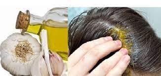 علاج الصلع الوراثي بالثوم وزيت الزيتون مقال