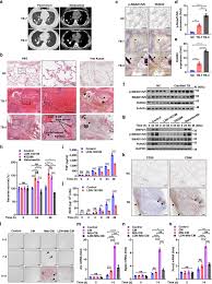 A misdiagnosis of early symptoms can significantly impact a patient's outcome and quality of life. Lung Gene Expression Signatures Suggest Pathogenic Links And Molecular Markers For Pulmonary Tuberculosis Adenocarcinoma And Sarcoidosis Communications Biology