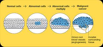 If you're getting a biopsy or want to understand your pathology report better, you might be interested to hear more about cancer cell histology and what cancer looks like. What Is Advanced Cancer Cancer Council Nsw