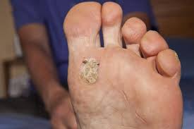 When my son was 8 years old i noticed that he had a few warts on his fingers. What Are Plantar Warts And How Do You Get Rid Of Them Health Com
