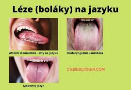 Image result for Puchýře na jazyku
