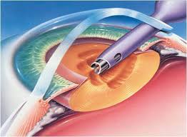 Image result for Cataract Extraction