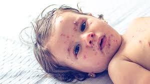 Image result for measles