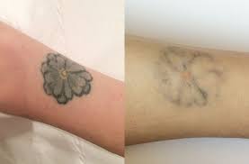 While your tattoo may seem — and it was intended to be — permanent, the wide variety of photos shown in our before and after laser tattoo removal gallery show that the experts at medermis laser clinic are able to completely remove the pigment, giving you fresh and clean skin. Laser Tattoo Removal What It S Really Like To Have A Tattoo Removed