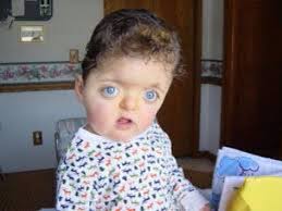 Cdc's official twitter source for daily credible health & safety updates from centers for disease control & prevention. Apert Syndrome By Cohenbla000 Cohenbla000