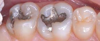 Temporary Fillings Why Would You Need One Sedation And Implant Dentistry Irvine