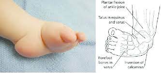 Openstax college, april 2013 in clubfoot, the tendons on the inside of the leg are shortened, the bones have an unusual shape, and the. Child With Clubfoot Deformity Download Scientific Diagram