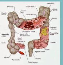 Hay pruebas para evaluar la misma. 27 Sigmoid Colon Ideen Naturliche Darmreinigung Darmreinigung Rezepte Darmreinigung Diat