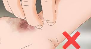 After rinsing the wound, you can clean it with cool running water and a mild soap. How To Treat Carpet Burns With Pictures Wikihow