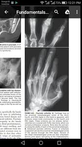 Psoriatic Arthritis Erosion Not Sharply Marginated Proximal Interphalangeal Joint