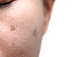 Orientation diagnostic pour un traitement selon la cause, pruritus of the skin: Coup D Envoi De La Campagne Euromelanoma Qui Depiste Gratuitement Le Cancer De La Peau Le Specialiste