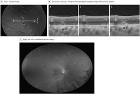 Ocular manifestations of emerging viral diseases | Eye