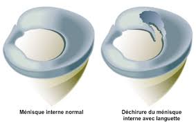 Le genou est protégé par le ménisque, un disque caoutchouteux en forme de « c ». Pathologie Meniscale