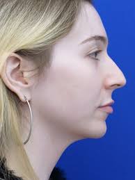 Dorsal Hump and Tension Tip 4281