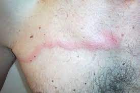 Possible causes of penile mondor's disease 7. Mondor S Disease Causes Symptoms Diagnosis Treatment Prognosis