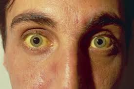 Purpura could also be caused by a minor trauma to your skin that causes your to have some hemorrhaging under the surface of your skin. Case Study A Transient Purpuric Rash With Vomiting Gponline