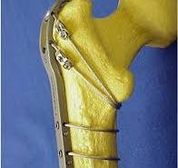 Greater trochanter fixed with a claw plate and cable system ...