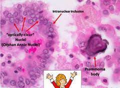 Check spelling or type a new query. Usmle High Yield On Twitter Papillary Thyroid Carcinoma Findings Are Orphan Annie Eye Nuclei And Papillae Often Associated With Psammoma Bodies Http T Co Bddfbwn5qx