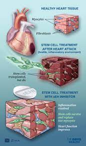 Chronic inflammation plays a key role in development of atherosclerosis. Stem Cell Treatment For Heart Failure Illustration Image Eurekalert Science News
