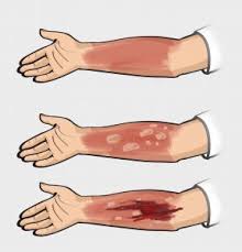 Your skin may still be discolored at this point, and there's a risk of permanent scarring. Burns Sepsis Alliance