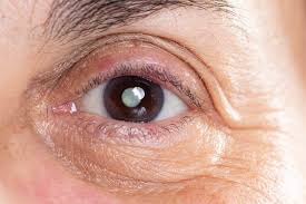 Image result for Cataract