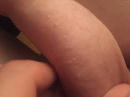 Ich Habe Seit Uber 2 Jahren Solche Pickel Oder Pilze Ich Weiss Nicht Was Es Ist Auf Meiner Vorhaut Am Penis Und Tut Nicht Weh Oder So Aber Muss Ich Etwas Tun