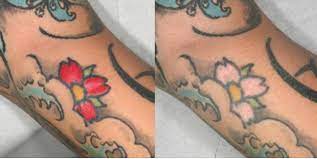 Red ink is incredibly hard to remove; Laser Tattoo Removal Results And Issues The Pmfa Journal