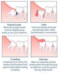 Sometimes health insurance will cover wisdom teeth removal— in whole or in part—if it is considered medically necessary, for instance, if it is considered medically necessary due to the extent of damage they can cause to surrounding teeth. Wisdom Tooth Extraction Houston Tx Summit Dental Centers