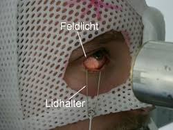 Proton therapy treatment, or proton radiation therapy, is the most precise and advanced form of radiation beam therapy available today. Protonentherapie Berlinprotonen Protonentherapie Von Augentumoren Charite Universitatsmedizin Berlin