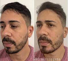Jan 07, 2020 · carlinhos maia o influencer se submenteu à técnica de redefinição mandibular, que segundo o médico responsável pelo procedimento, tem como objetivo remodelar o contorno facial, melhorando a. Carlinhos Maia Muda Formato Do Rosto Com Procedimento E Resultado Chama Atencao