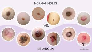 They most often develop in areas that have had exposure to the sun, such as your back, legs, arms and face. About Melanoma Signs Causes And Prevention
