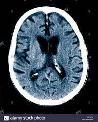 It also helps to help. Ct Scan Ein 84 Jahre Alter Mann Mit Alzheimer Krankheit Ct Zeigt Hirnatrophie Stockfotografie Alamy