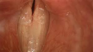 Image result for Acute Laryngitis