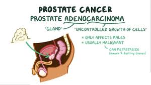 Prostate cancer is the ___ leading cause of cancer related death in men. Prostate Cancer Nclex Quizlet Fonction De Math