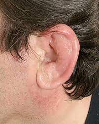 Hallo, meine freundin hat seit gestern einen geschwollenen ohrgang. Perichondritis Wikipedia