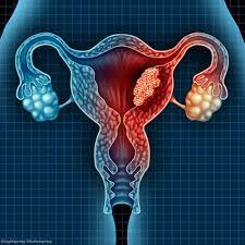 Most women with pmb will not have significant pathology but the dictum remains that postmenopausal bleeding is cancer until proved otherwise. Postmenopausal Bleeding Common In Women With Endometrial Cancer