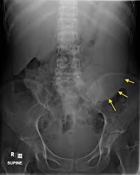 Image result for Splenomegaly