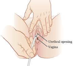 Should i worry about the size of my labia? Self Catheterization For Females Memorial Sloan Kettering Cancer Center